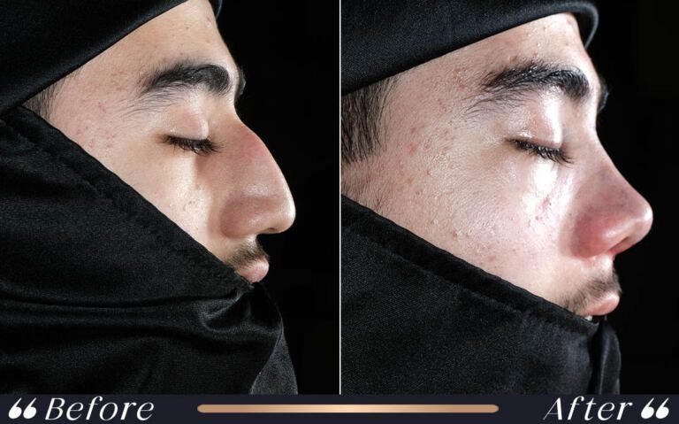 Rhinoplasty_Nose_Yesilkoy_Clinic