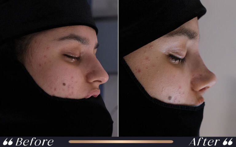 Rhinoplasty_Surgery_Yesilkoy_Clinic
