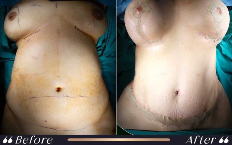 abdominoplasty_20