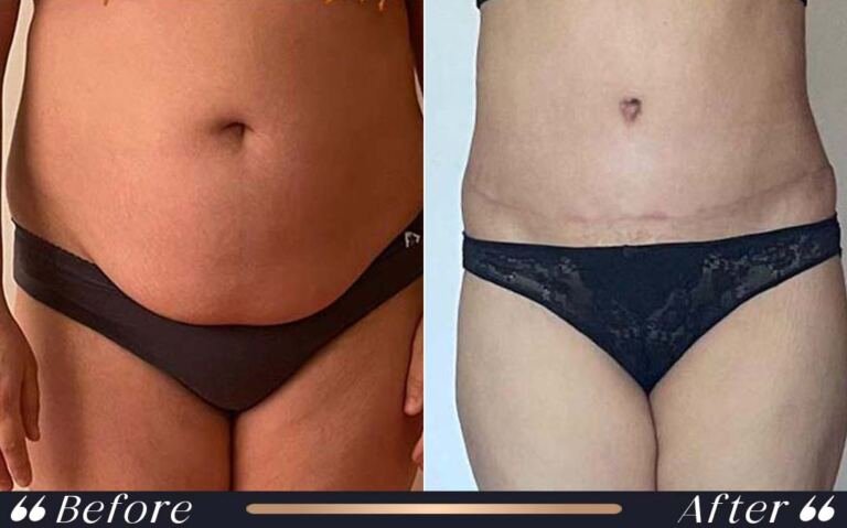 abdominoplasty_4