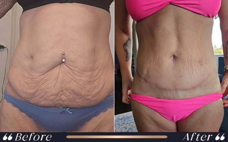 abdominoplasty_5