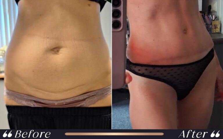 abdominoplasty_8