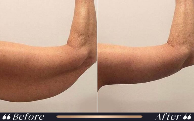 arm_lift