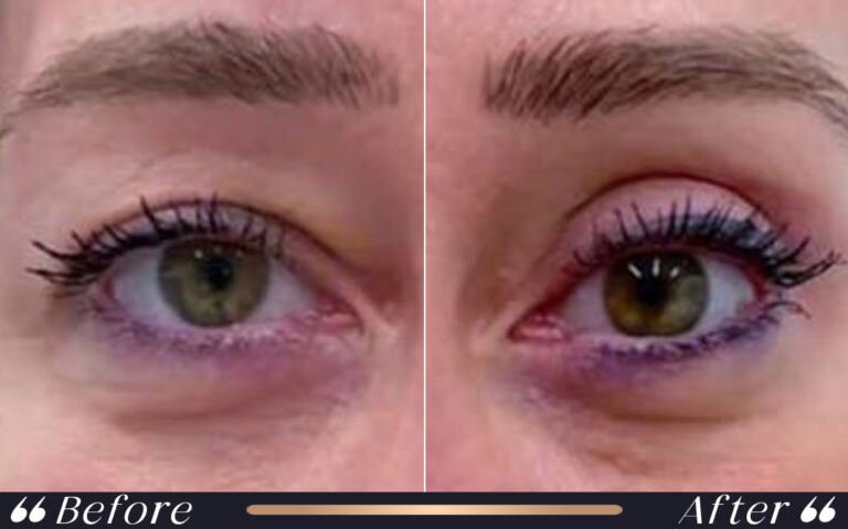 blepharoplasty_13