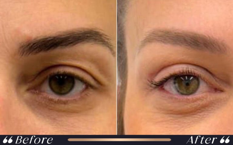 blepharoplasty_14