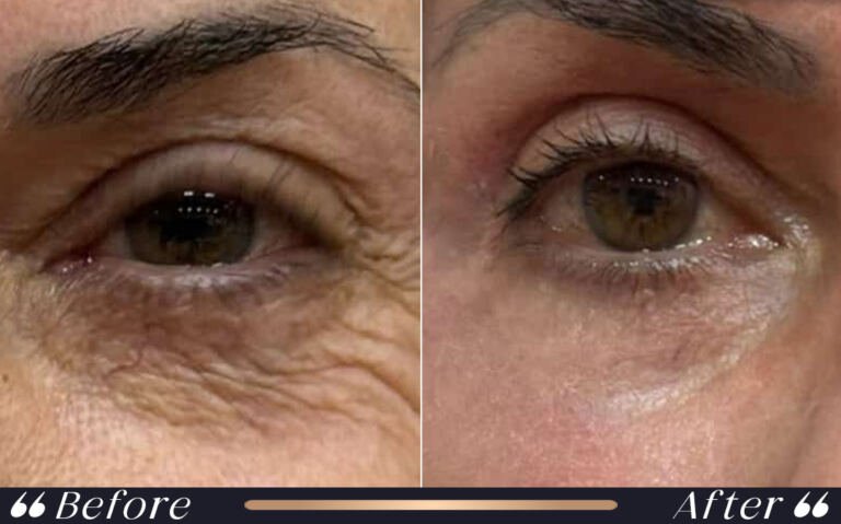 blepharoplasty_23