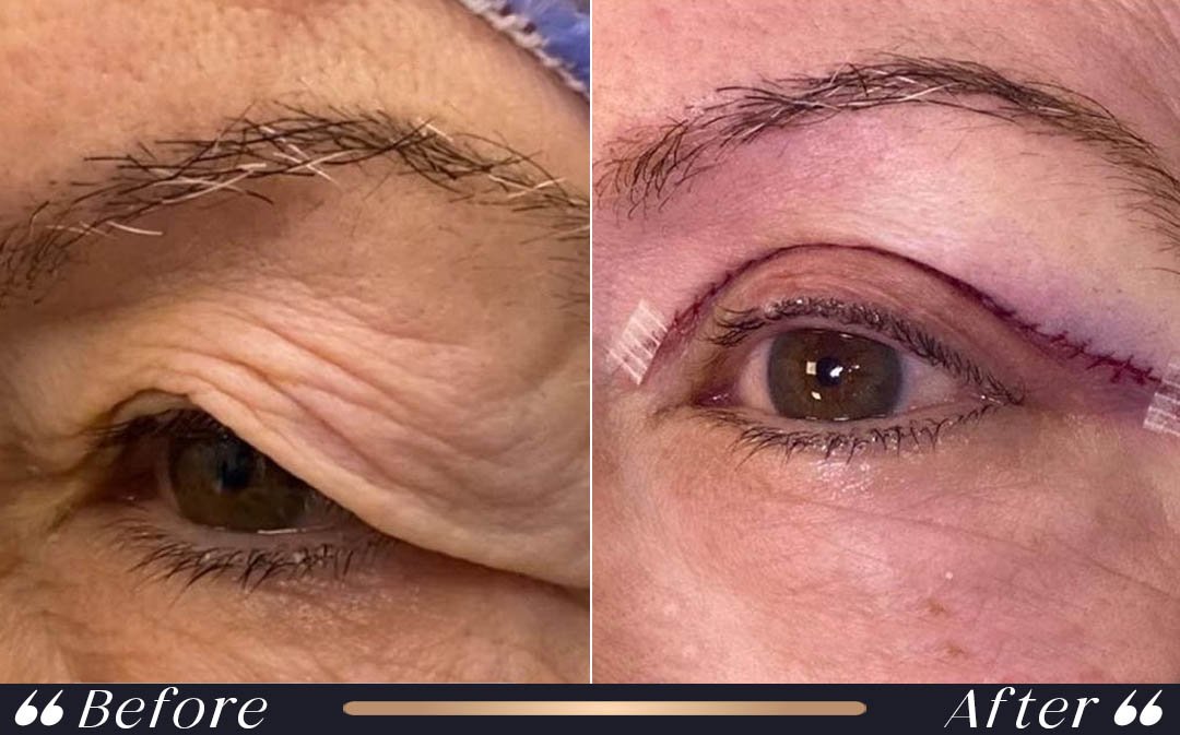 Upper blepharoplasty Turkey cost specialist eyelid surgery Istanbul