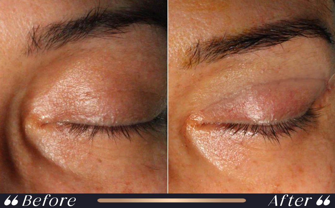 Blepharoplasty Before and After