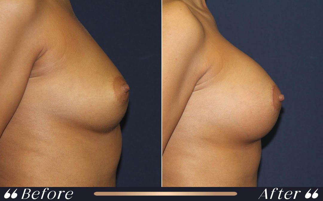 Breast augmentation after pregnancy with breast implants