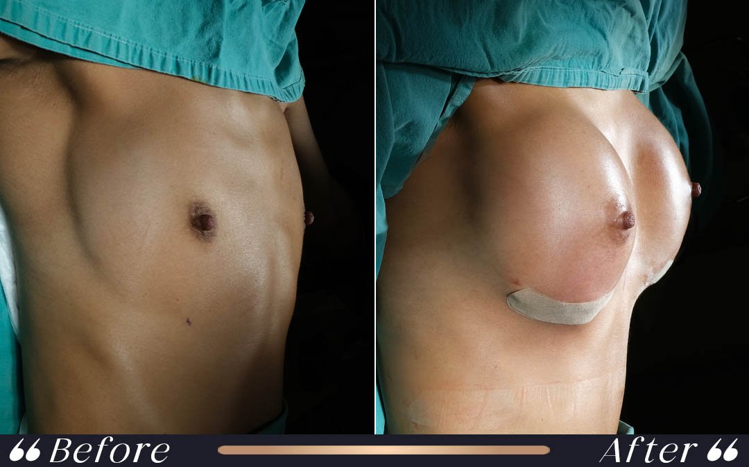 Breast augmentation recovery final results Yeşilköy Clinic Istanbul