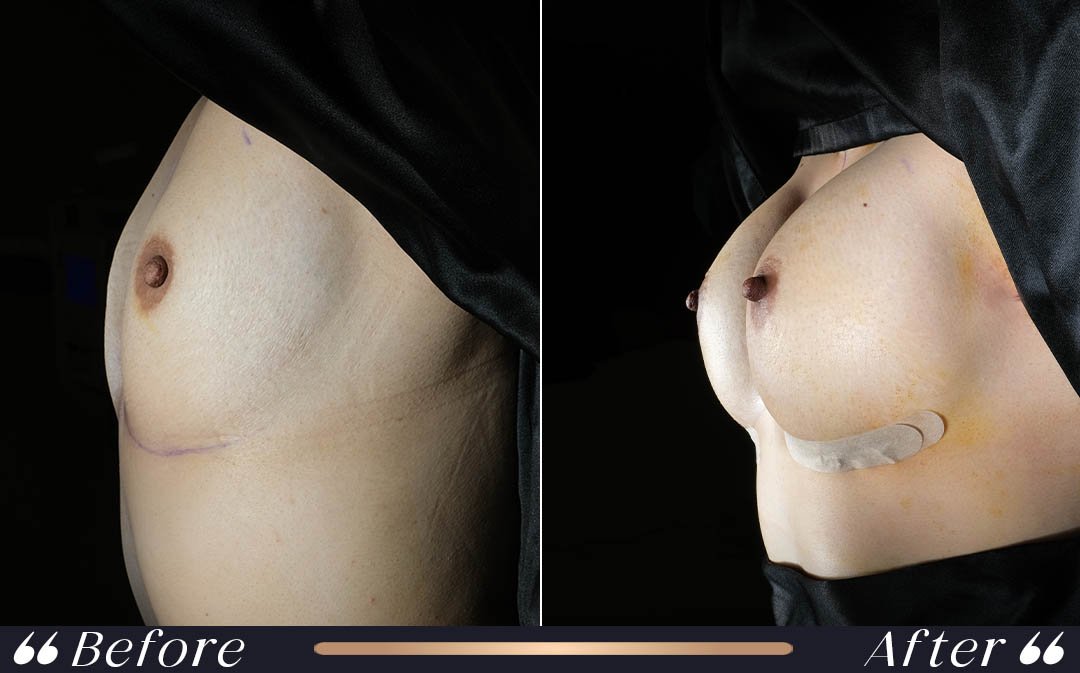 Breast Implant at Yesilkoy Clinic