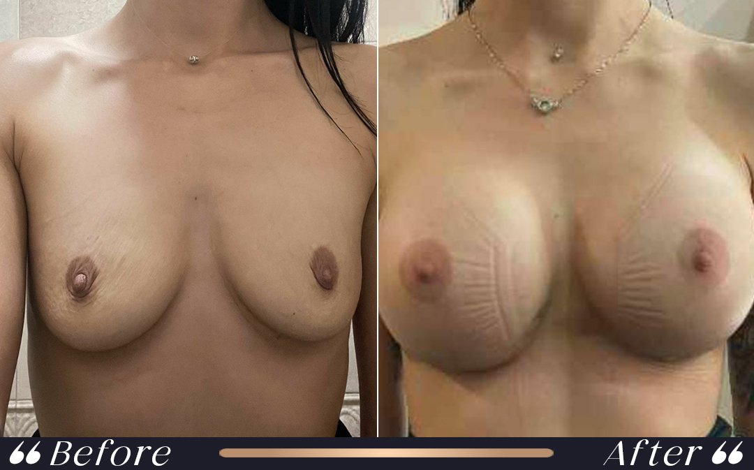 breast lift procedure in breast lift vs augmentation comparison