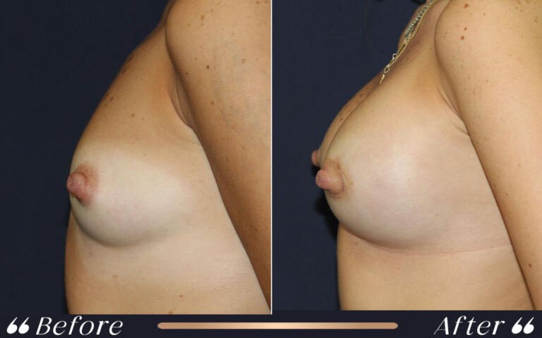 breast_18