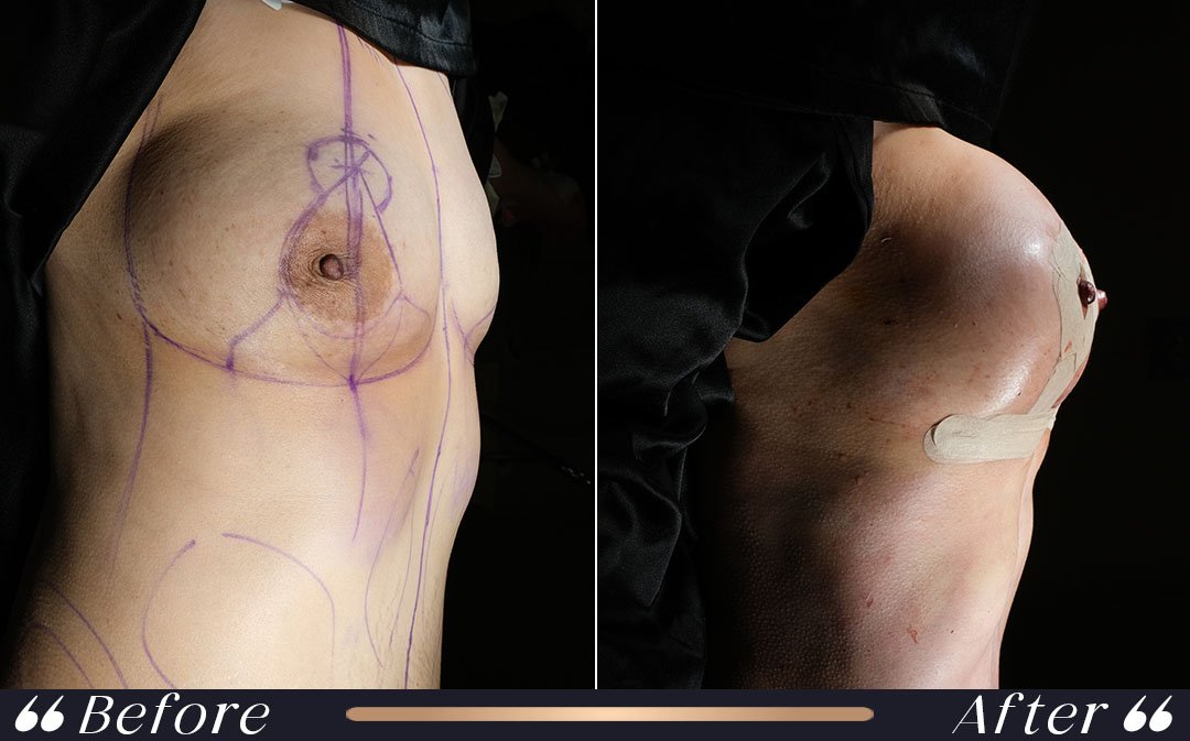 Breast augmentation recovery support bra and implant settling