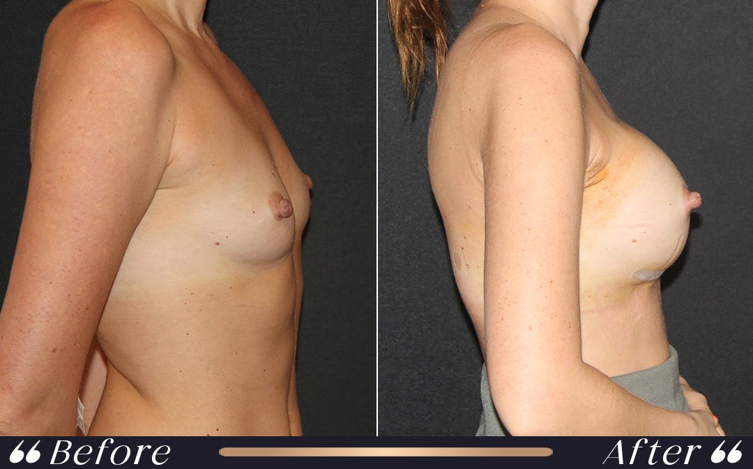 Breast Implant at Yesilkoy Clinic
