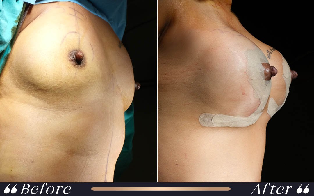 Breast Implant at Yesilkoy Clinic