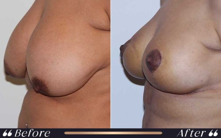 breast_lift_11