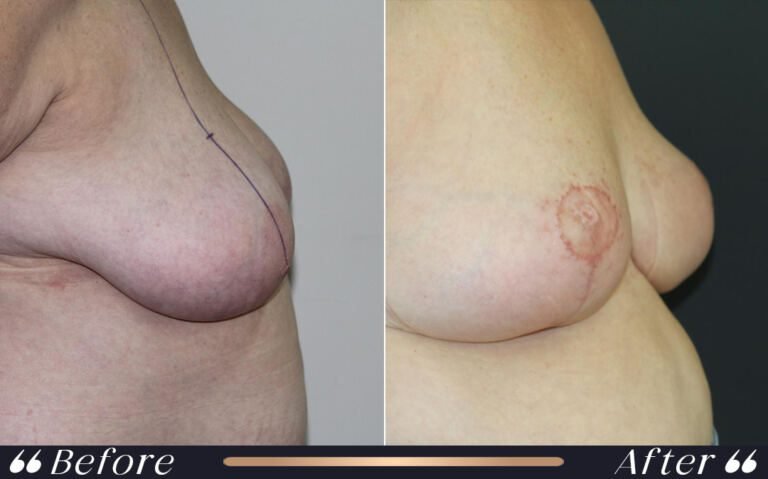 breast_reduction_6