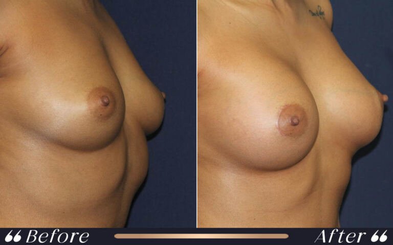 breast_silicon_10