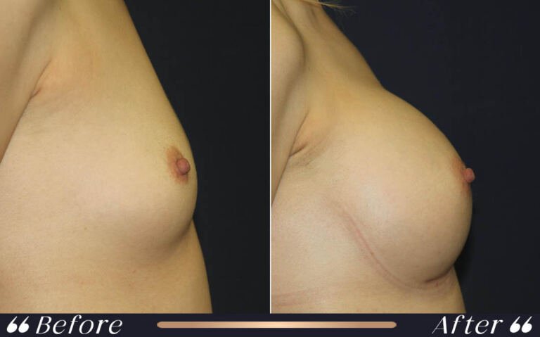 breast_silicon_13
