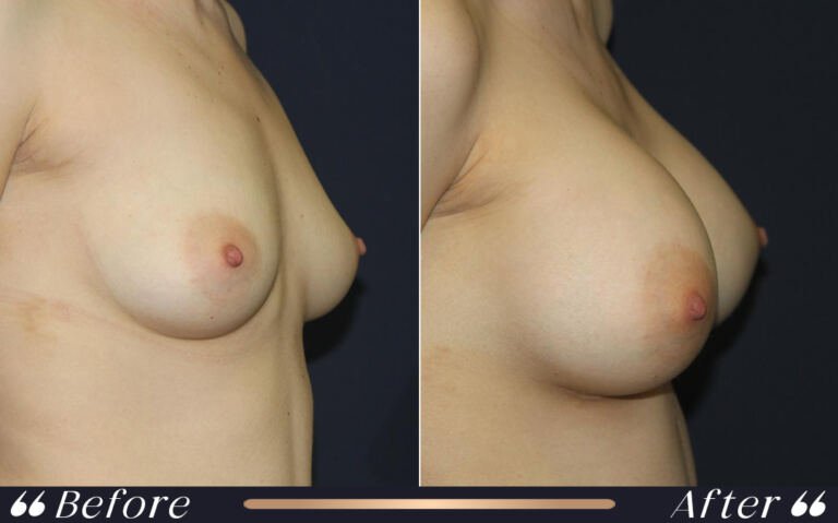 breast_silicon_25