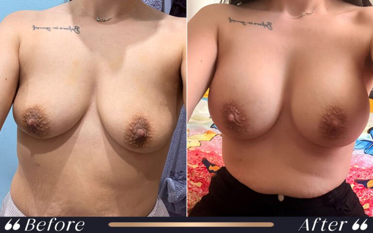 breast_silicon_29