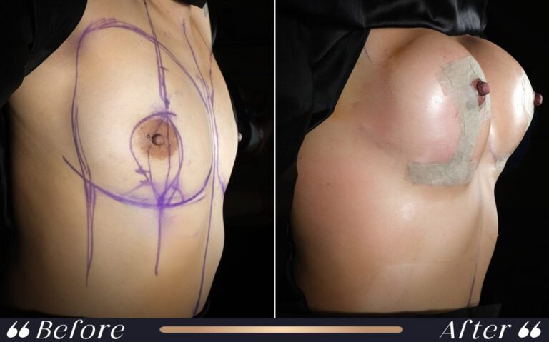 breastlift