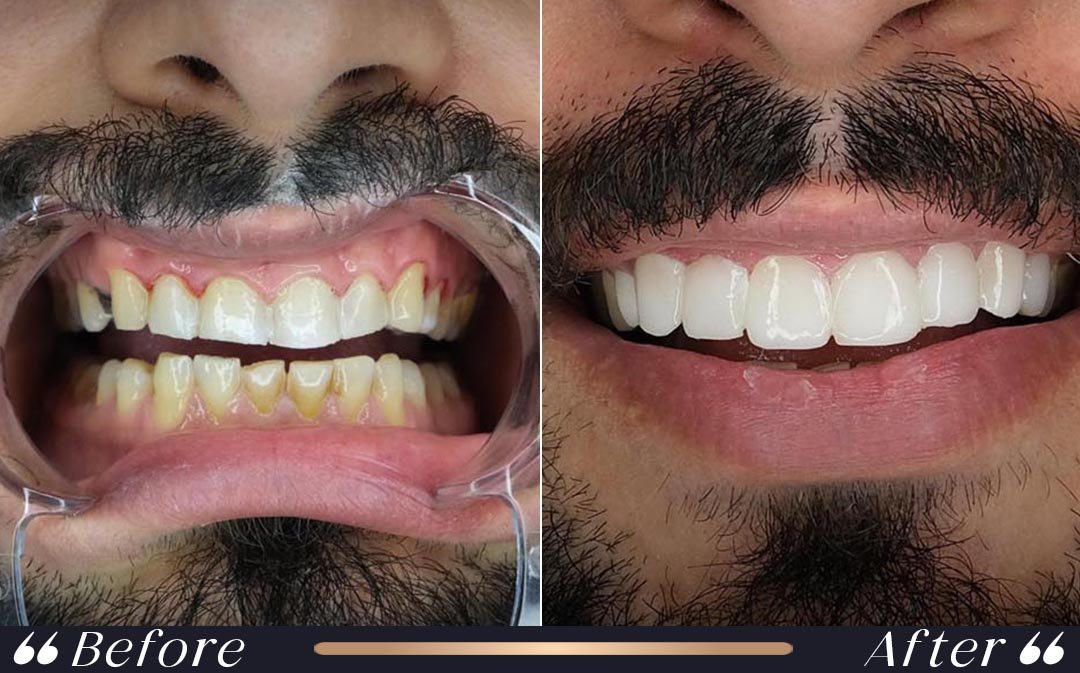 Veneers Turkey cost 2026 cosmetic dentistry at Yeşilköy Clinic