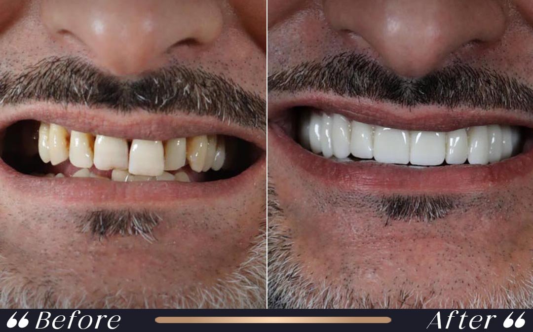 Composite veneers Turkey cost and cosmetic smile treatment