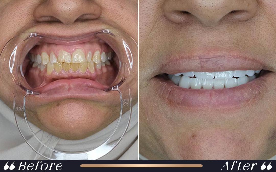 Veneers Turkey cost specialist cosmetic dentistry Yeşilköy Clinic Istanbul