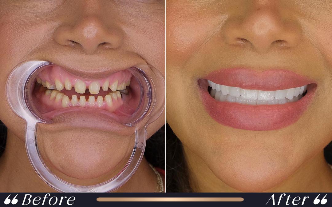 veneers vs zirconium crowns comparison at Yesilkoy Clinic