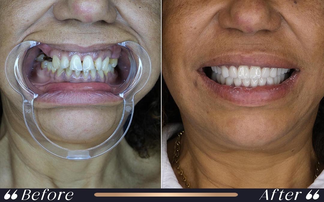 Dental Crowns at Yesilkoy Clinic