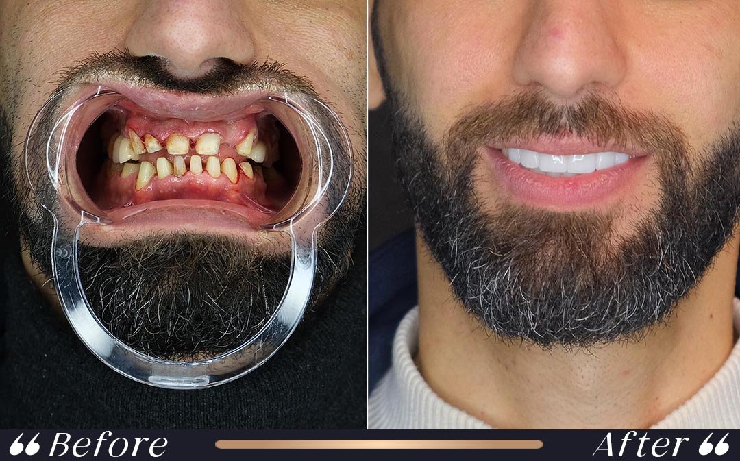 dental veneers in veneers vs zirconium crowns comparison