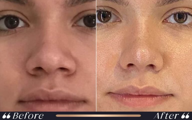 ethnic_rhinoplasty_2
