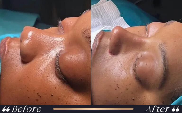 ethnic_rhinoplasty_9