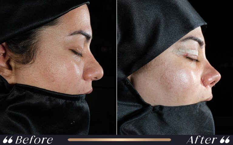 ethnicrhinoplasty