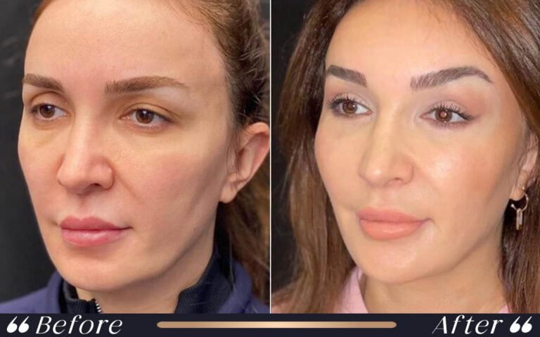 eyebrownlift