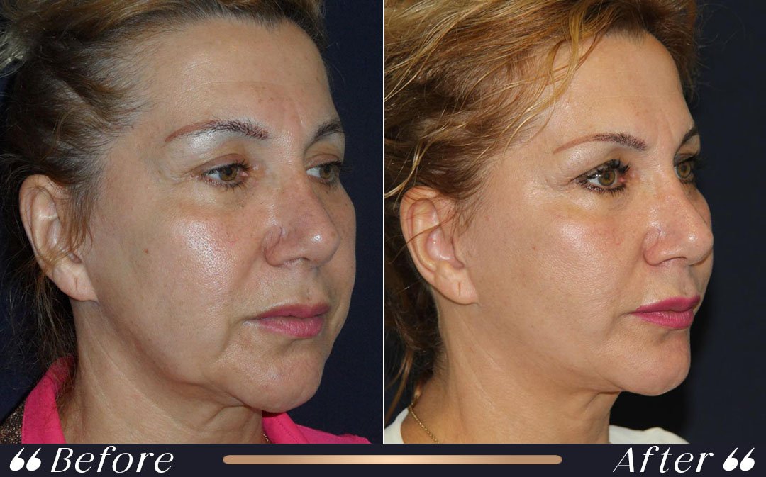 Facelift turkey cost specialist doctor treatment at Yesilkoy Clinic