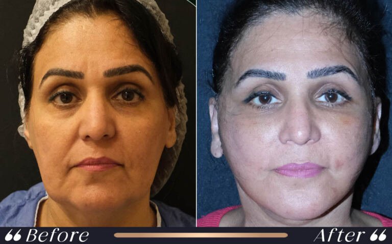 face_and_neck_18