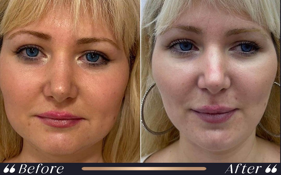 Mini Facelift at Yesilkoy Clinic