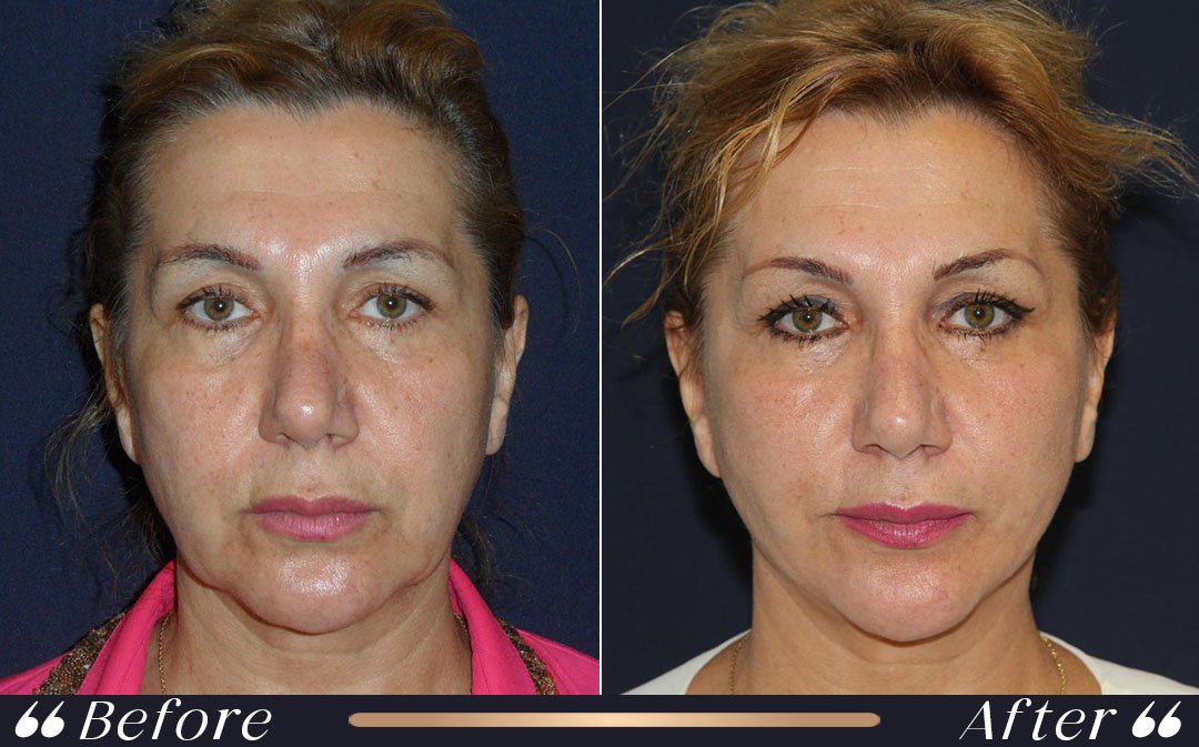 Facelift turkey cost 2026 at Yesilkoy Clinic Istanbul