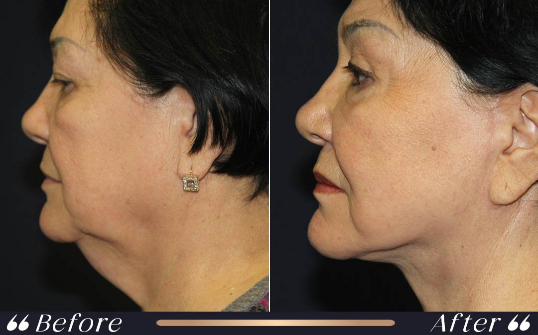 Facelift Before and After