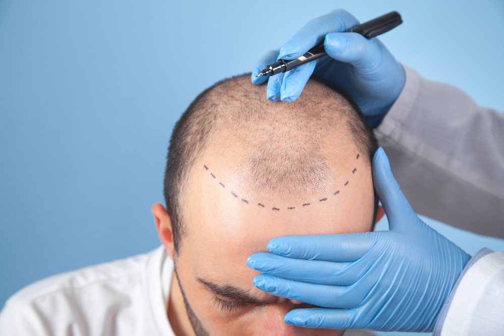 fue vs dhi hair transplant treatment planning