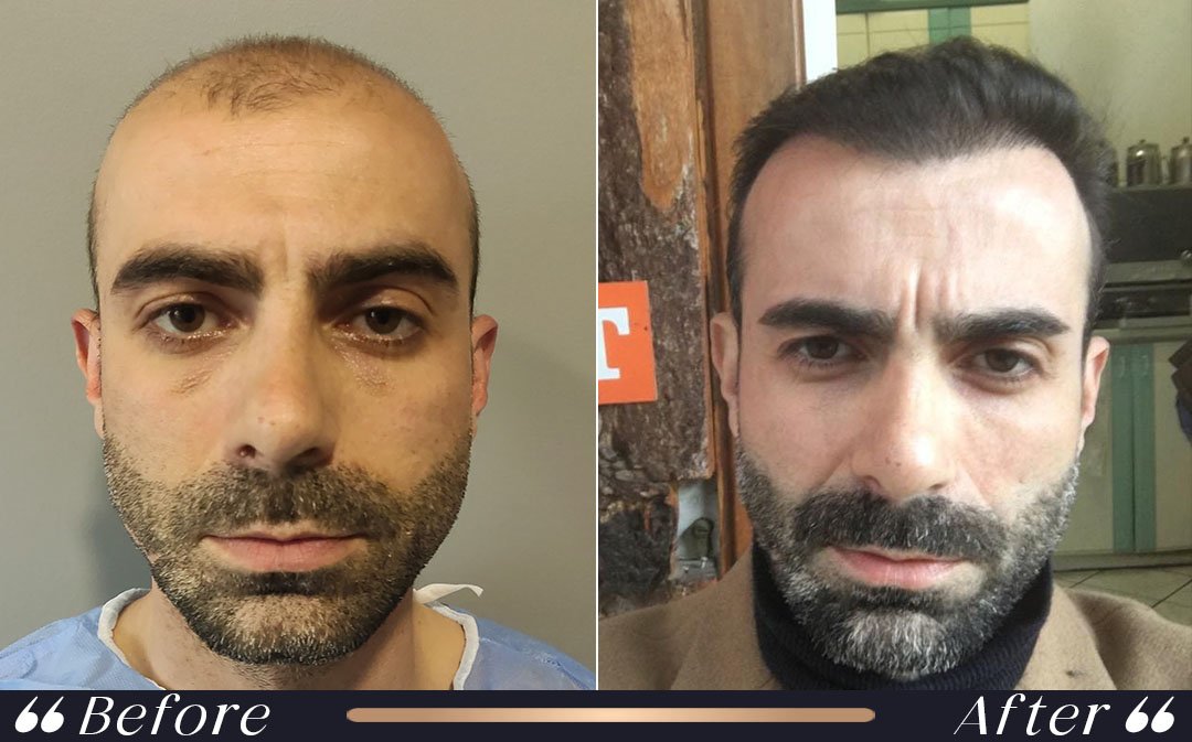 When Can I Fly After Hair Transplant? when can i fly after hair transplant at Yesilkoy Clinic