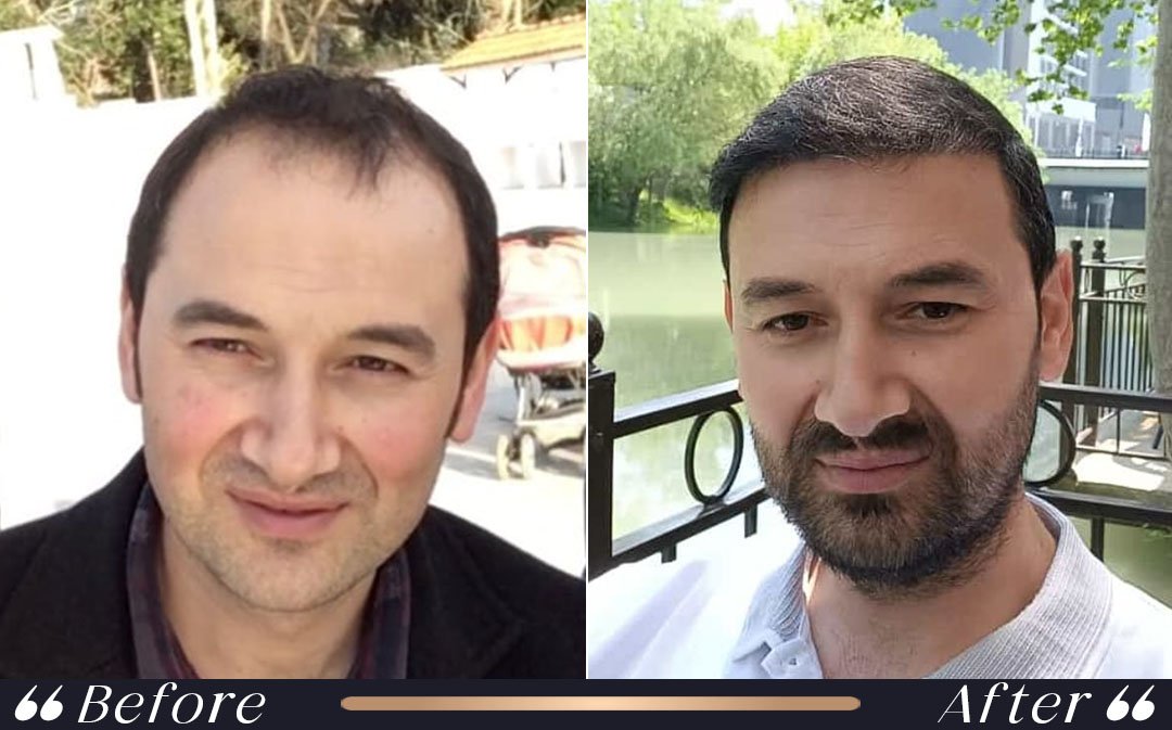 Flying After Hair Transplant From Istanbul when can i fly after hair transplant from Istanbul