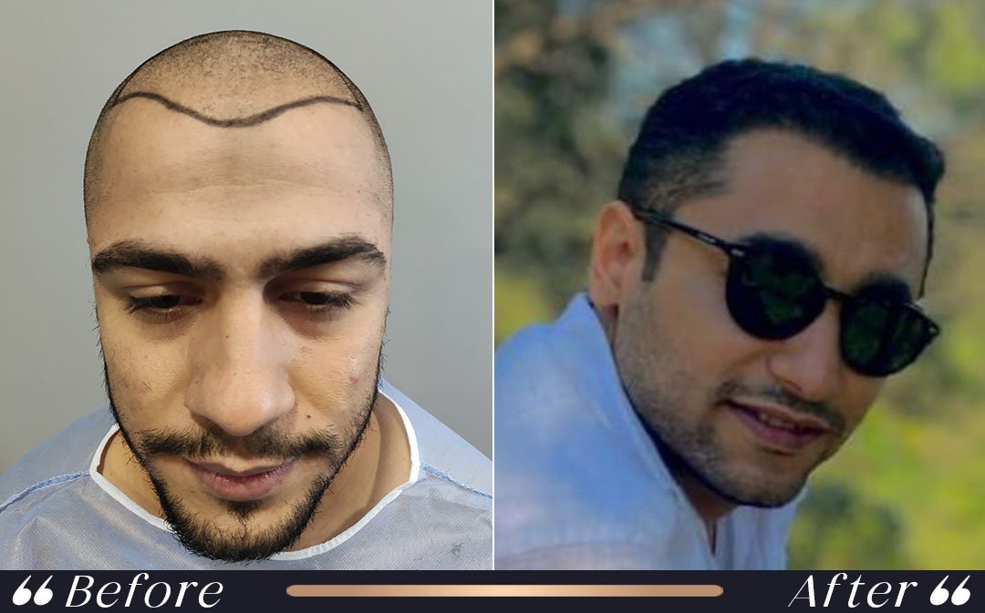Hair transplant recovery month 6 new hair growth