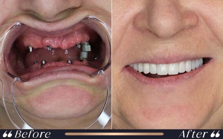 implant_6