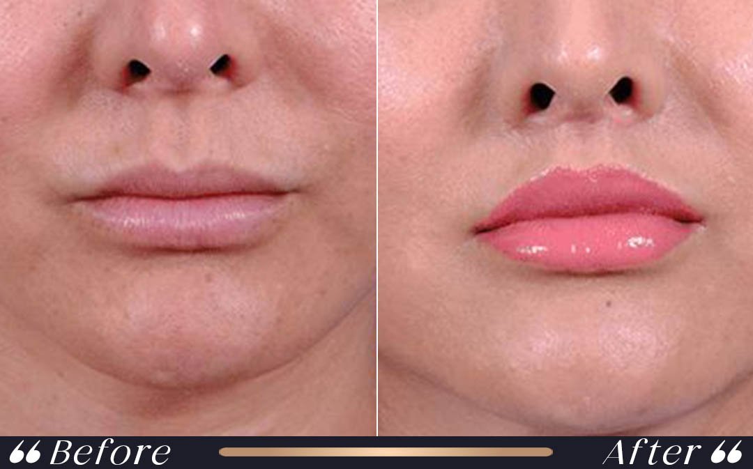 Lip Lift Before and After