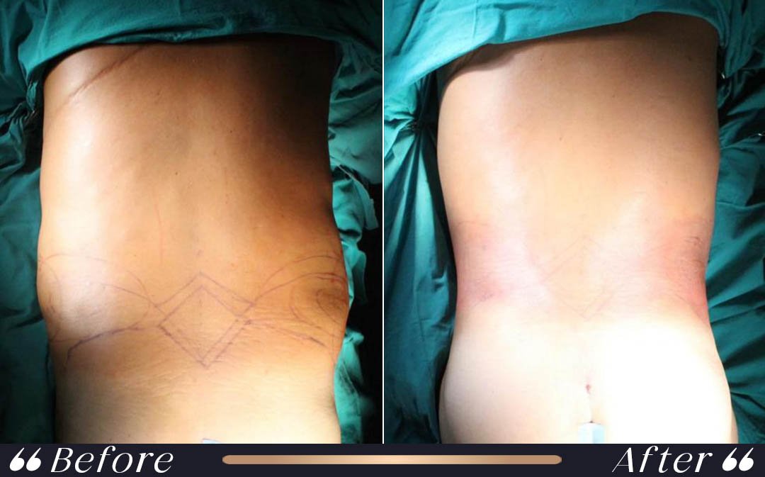 belly fat treatment liposuction vs tummy tuck