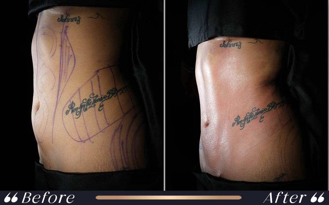 Liposuction recovery before flying after surgery